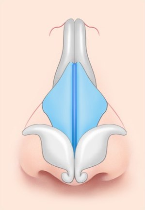 에이펙스성형외과 복코 성형 전 코뼈와 비중격, 넓게 벌어진 날개 연골 구조를 나타낸 해부도 일러스트