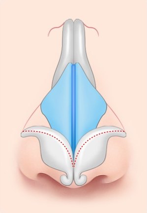 복코 성형을 위해 코끝 날개 연골의 절제 부위를 붉은 점선으로 표시한 코 연골 구조 도해