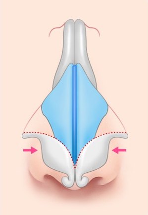 복코 성형 과정에서 코끝 연골을 가운데로 모아 묶어주는 단계를 설명하는 코 내부 연골 구조 도해