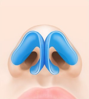 복코 성형 수술 전 아래에서 바라본 콧구멍과 좌우로 벌어진 파란색 비익연골 구조 도해