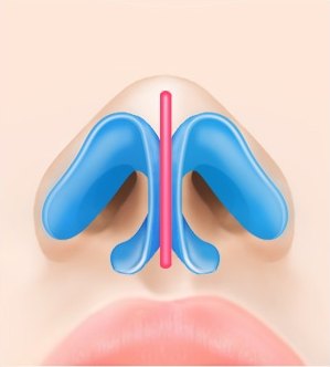 복코 성형을 위해 코끝 비익연골 사이에 분홍색 비주 지지대를 세워 고정하는 과정을 나타낸 아래 각도의 일러스트