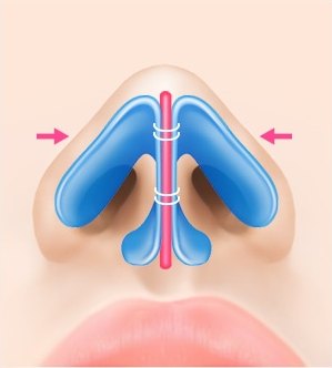 에이펙스성형외과 복코 성형에서 벌어진 비익연골을 중앙으로 모아 봉합사로 고정하는 수술 과정을 나타낸 도해