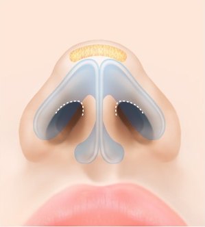 아래에서 본 코의 내부 연골 구조와 콧구멍 안쪽 점선 절개 부위를 보여주는 복코 성형 수술 과정 도해