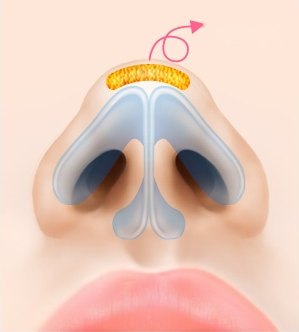 복코 성형을 위해 코끝 내부의 두꺼운 지방층을 확인하고 화살표 방향으로 지방을 제거하는 수술 과정을 나타낸 도해