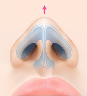 복코 성형 과정에서 코끝 연골을 모아 위로 올려 높여주는 원리를 나타낸 아래에서 본 코 일러스트 도해