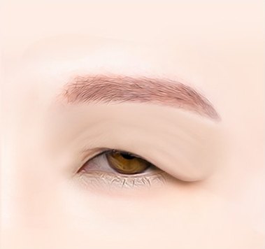 눈썹거상술 대상인 눈꺼풀 피부가 처져 눈꼬리와 시야를 덮은 눈 부위 일러스트