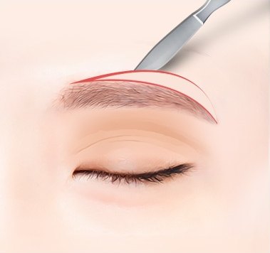 눈썹거상술을 위해 눈썹 윗부분을 붉은 절개선으로 표시하고 수술용 메스로 절제하는 과정을 나타낸 의학 일러스트