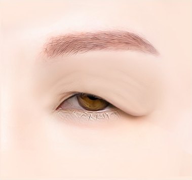 눈썹거상술 수술 전 눈꺼풀 피부가 늘어져 눈꼬리와 동공 일부를 덮고 있는 눈매 일러스트