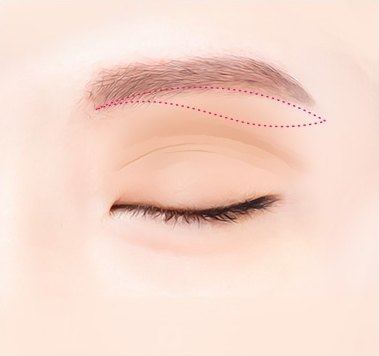 눈썹거상술을 위해 눈을 감은 상태에서 눈썹 아래 라인을 따라 붉은 점선으로 절개 부위를 디자인한 일러스트