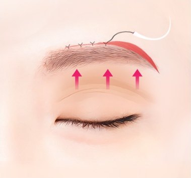 눈썹거상술 과정에서 눈썹 위 절개 부위를 실로 봉합하고 눈꺼풀 피부를 위로 리프팅하는 모습을 나타낸 의학 일러스트