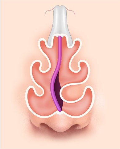 휜코 성형과 관련된 비중격만곡증에서 비중격이 한쪽으로 C자 형태로 휘어져 비강 통로가 좁아진 코 내부 단면 구조 도해