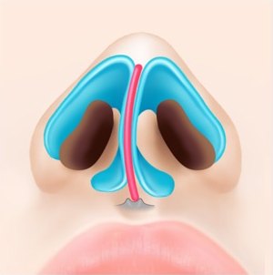 휜코 성형을 위해 아래에서 본 콧구멍 내부와 휘어진 비중격 및 비익연골 구조를 나타낸 해부학 일러스트