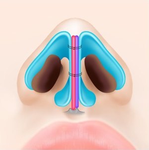 휜코 성형을 위해 코끝 비익연골과 비중격연골 사이에 연골을 덧대어 실로 묶어 고정한 수술 원리 도해