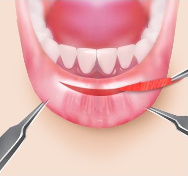 아랫입술 안쪽 점막을 절개하여 근육 조직을 절제하는 입술성형 수술 과정 도해