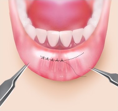 입술성형 수술 과정 중 핀셋으로 아랫입술 안쪽 점막을 노출하고 절개선을 따라 미세 봉합을 진행하는 의학 일러스트