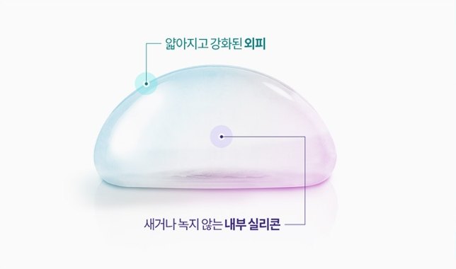 가슴확대 수술에 사용되는 보형물의 얇아지고 강화된 외피와 새거나 녹지 않는 내부 실리콘 구조를 설명하는 도해