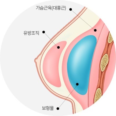 가슴확대 수술 시 대흉근 아래에 보형물이 위치하는 구조를 나타낸 유방 해부학 단면 도해