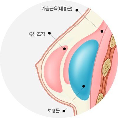 가슴확대 수술 시 대흉근과 유방조직 아래에 위치한 보형물 구조를 나타낸 해부학 단면 도해