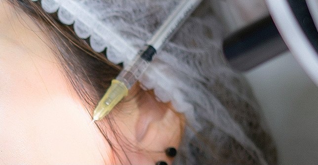 헤어캡을 착용한 환자의 관자놀이와 이마 헤어라인 부근에 주사기로 보톡스 시술을 진행하는 모습