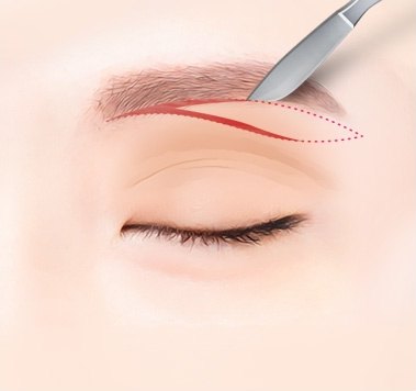 눈썹하거상 수술 과정에서 눈썹 바로 아래 절개 라인을 따라 메스로 절개하는 모습을 나타낸 일러스트