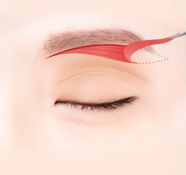 눈썹하거상술 과정에서 눈썹 바로 아래의 늘어진 피부를 절제하여 박리하는 수술 단계를 나타낸 일러스트
