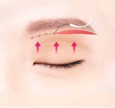 눈썹하거상술 과정에서 눈썹 밑 절개 부위를 미세 봉합하고 처진 눈꺼풀이 리프팅되는 원리를 보여주는 그래픽