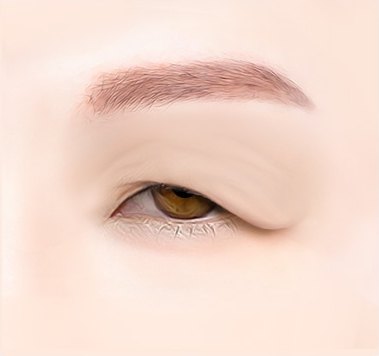 상안검 수술 전 처진 눈꺼풀 피부가 눈동자를 덮고 있는 눈매 형태 일러스트