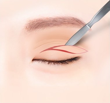 감은 눈꺼풀에 상안검수술 절개 라인을 붉은 선으로 디자인하고 메스로 절개하는 과정을 나타낸 일러스트
