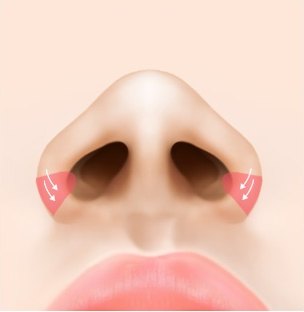 아래에서 올려다본 코 일러스트에서 콧볼축소를 위해 양쪽 콧날개 외측 절제 부위와 축소 방향 화살표를 표시한 도해