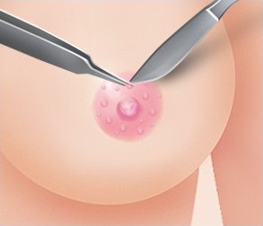 유륜 돌기 제거 수술 과정에서 핀셋과 메스를 이용해 유륜 부위의 몽고메리 결절을 절제하는 도해 일러스트