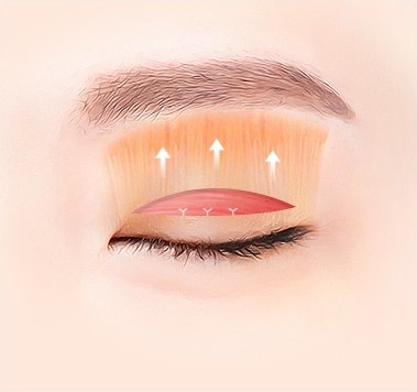 رسم توضيحي يُظهر ألياف العضلة الرافعة داخل الجفن مع سهم للأعلى وعلامات الخياطة