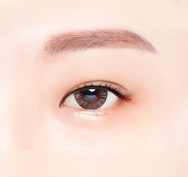 뒤트임 성형 과정을 보여주기 위해 눈꼬리 바깥쪽 절개선을 붉은 선으로 표시한 눈 그래픽