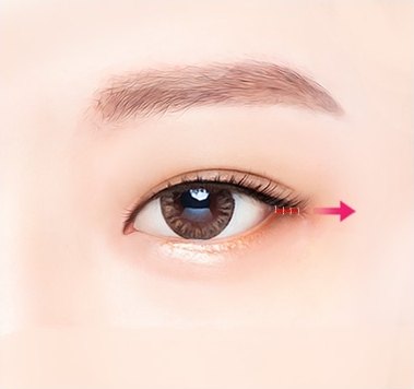 눈꼬리 끝부분의 절개선과 바깥쪽 방향 화살표로 뒤트임 수술 진행 과정을 설명하는 안내 도해