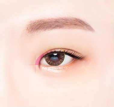 앞트임과 윗트임 수술 디자인을 위해 눈 앞머리 절개 부위를 핑크색 선으로 표시한 눈 도해