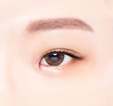 앞트임 수술 시 눈 안쪽 구석의 몽고주름 절개선을 점선으로 표시한 눈 클로즈업 도해