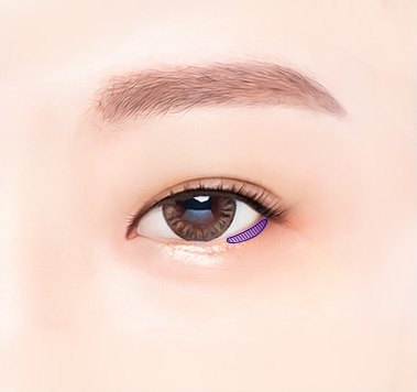 에이펙스성형외과 트임성형 안내 중 눈꼬리 아래쪽 절개 및 당김 부위를 보라색 빗금으로 표시한 밑트임 수술 도해