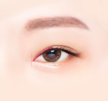 눈 앞머리 위쪽 라인을 절개하여 교정 범위를 표시한 윗트임 수술 디자인 도해