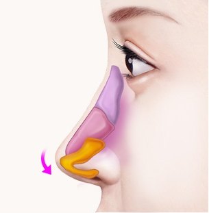 짧은코 성형을 위해 코 내부 뼈와 연골 구조를 색상별로 구분하고 코끝을 아래 방향으로 내리는 과정을 나타낸 도해