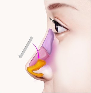 짧은코 및 들창코 성형 시 코뼈와 비중격, 날개연골 구조에 보형물을 삽입하는 수술 과정을 설명하는 의학 일러스트