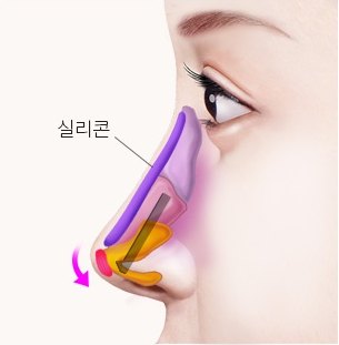 짧은코 들창코 성형 시 콧대에 실리콘 보형물을 삽입하고 코끝 연골을 재배치해 길이를 늘리는 수술 원리 도해