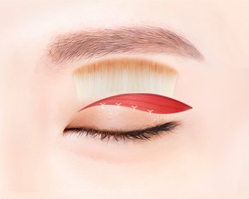 상안검 수술을 위해 눈꺼풀 절개 부위와 절제할 조직 범위를 붉은색 면과 봉합선으로 표시한 눈 도해
