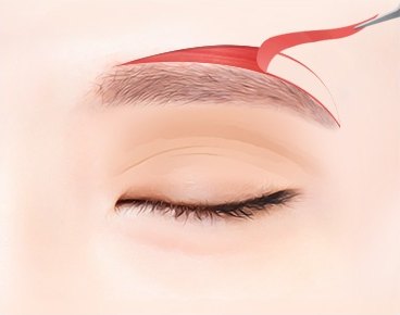 눈썹 바로 위쪽 피부를 절개 및 박리하는 눈썹위거상술 과정을 보여주는 눈 클로즈업 일러스트