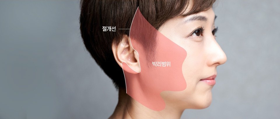 여성 옆모습에 안면거상 절개선과 뺨 및 턱선 부위의 박리 범위를 분홍색 영역으로 표시한 SMAS안면거상 도해